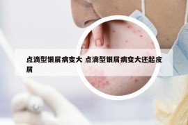 点滴型银屑病变大 点滴型银屑病变大还起皮屑