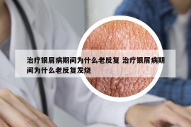 治疗银屑病期间为什么老反复 治疗银屑病期间为什么老反复发烧