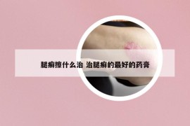 腿癣擦什么治 治腿癣的最好的药膏