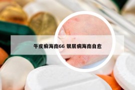 牛皮癣海南66 银屑病海南自愈