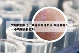 大腿内侧长了一块像癣用什么药 大腿内侧长一小块癣会自愈吗