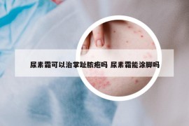 尿素霜可以治掌趾脓疱吗 尿素霜能涂脚吗