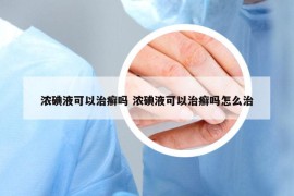 浓碘液可以治癣吗 浓碘液可以治癣吗怎么治