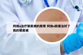 阿维a治疗银屑病的原理 阿维a胶囊治好了我的银屑病