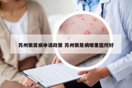 苏州银屑病申请政策 苏州银屑病哪里医院好