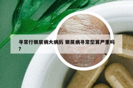 寻常行银屑病大病历 银屑病寻常型算严重吗?