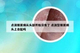 点滴银屑病从头部开始没有了 点滴型银屑病头上会起吗