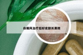 白癜风治疗后好皮肤长黑斑