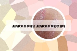 点滴状银屑病特征 点滴状银屑病能根治吗