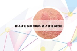 獾子油能治牛皮癣吗 獾子油治皮肤病