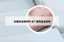 白癜风治得好吗 白广癜风能治好吗