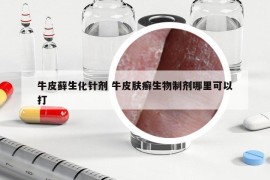 牛皮藓生化针剂 牛皮肤癣生物制剂哪里可以打