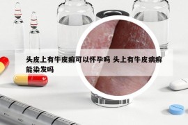 头皮上有牛皮癣可以怀孕吗 头上有牛皮病癣能染发吗