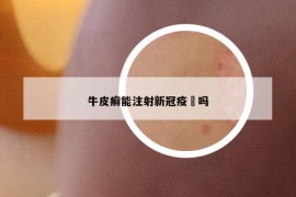 牛皮癣能注射新冠疫啇吗