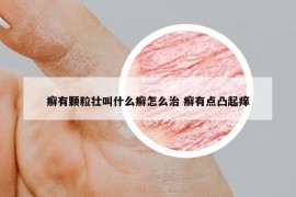 癣有颗粒壮叫什么癣怎么治 癣有点凸起痒