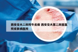 西安交大二附院牛皮癣 西安交大第二附属医院皮肤病医院