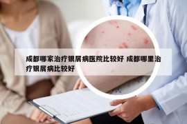 成都哪家治疗银屑病医院比较好 成都哪里治疗银屑病比较好