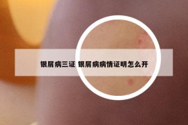 银屑病三证 银屑病病情证明怎么开