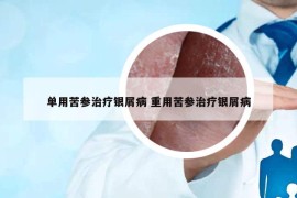 单用苦参治疗银屑病 重用苦参治疗银屑病