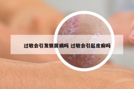 过敏会引发银屑病吗 过敏会引起皮癣吗