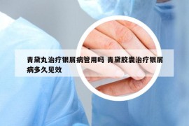 青黛丸治疗银屑病管用吗 青黛胶囊治疗银屑病多久见效