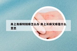 身上有癣特别痒怎么办 身上长癣又痒是什么意思