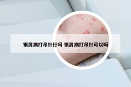 银屑病打吊针行吗 银屑病打吊针可以吗