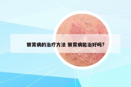 银霄病的治疗方法 银霄病能治好吗?