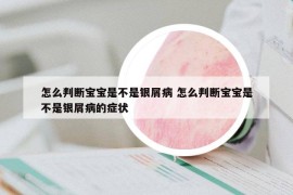 怎么判断宝宝是不是银屑病 怎么判断宝宝是不是银屑病的症状