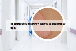 聊城银屑病医院哪家好 聊城银屑病医院哪家好点