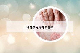 准分子光治疗白癜风