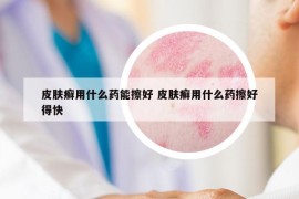 皮肤癣用什么药能擦好 皮肤癣用什么药擦好得快