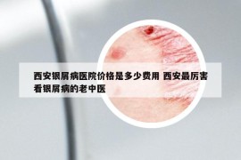 西安银屑病医院价格是多少费用 西安最厉害看银屑病的老中医