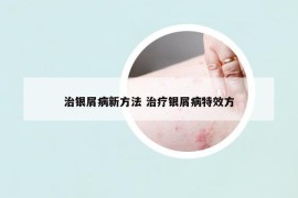 治银屑病新方法 治疗银屑病特效方