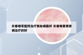 长春哪家医院治疗银血病最好 长春哪里银屑病治疗的好