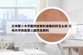 兰州第二大学医院皮肤科谁看的好怎么样 兰州大学附属第二医院皮肤科