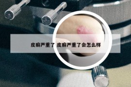 皮癣严重了 皮癣严重了会怎么样