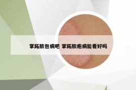 掌跖脓包病吧 掌跖脓疱病能看好吗