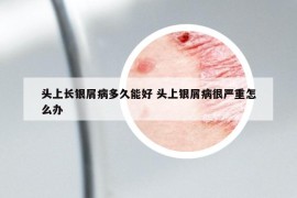 头上长银屑病多久能好 头上银屑病很严重怎么办