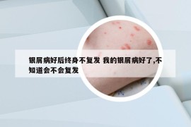 银屑病好后终身不复发 我的银屑病好了,不知道会不会复发