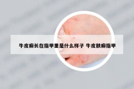 牛皮癣长在指甲里是什么样子 牛皮肤癣指甲