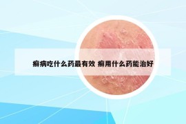 癣病吃什么药最有效 癣用什么药能治好