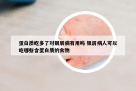 蛋白质吃多了对银屑病有用吗 银屑病人可以吃哪些含蛋白质的食物