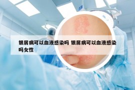 银屑病可以血液感染吗 银屑病可以血液感染吗女性