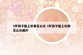 3岁孩子腿上长癣怎么办 3岁孩子腿上长癣怎么办图片