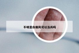 不明显白癜风可以当兵吗