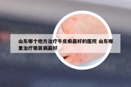 山东哪个地方治疗牛皮癣最好的医院 山东哪里治疗银屑病最好