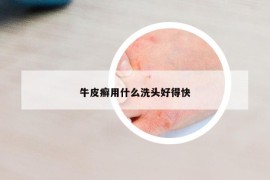 牛皮癣用什么洗头好得快