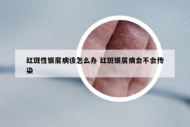 红斑性银屑病该怎么办 红斑银屑病会不会传染