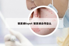 银屑病tspot 银屑病会传染么